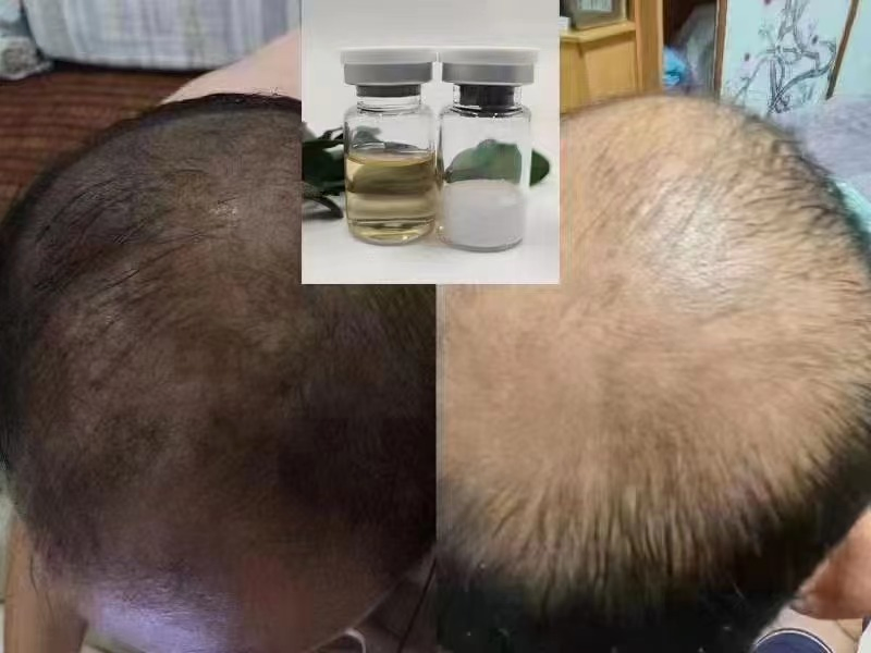 5ml 5% Hair Regrowth Oil Hair Care Loss Treatment Hair Growth Serum Kit Freeze-Dried Powder