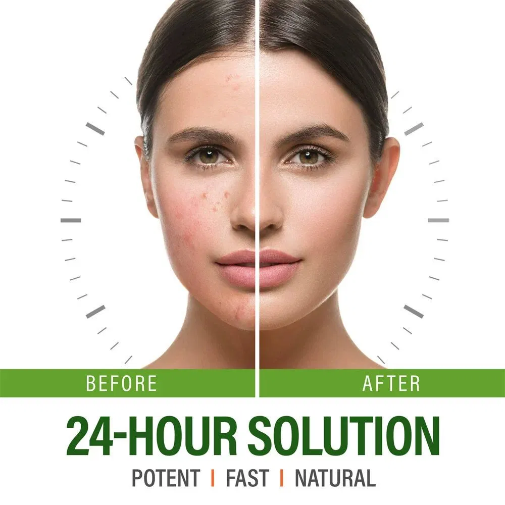 Fast Effective Acne Removal Cream Herbal Pimples Remove BHA Salicylic Acid Face Cream