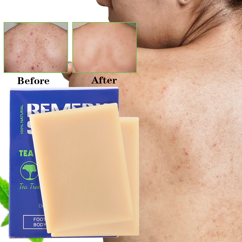 Refreshing Deep Cleansing Nourishing Remedy Remove Mites Anit-Acne Tea Tree Soap