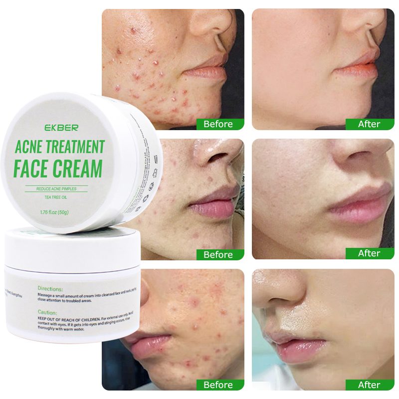 Plant Extract Luxury Anti-Acne Smoothing Salicylic Acid Face Cleansing Cream Plant Extract Anti-Acne Face Cream