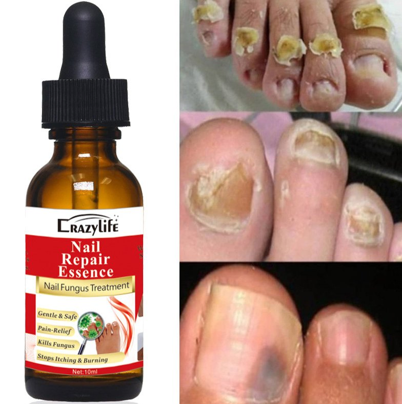 Online Wholesale Ready to Ship Spot Stock 10ml Effective Nail Repair Serum Essences Anti Fungus Remove Onychomycosis Toe Nourishing