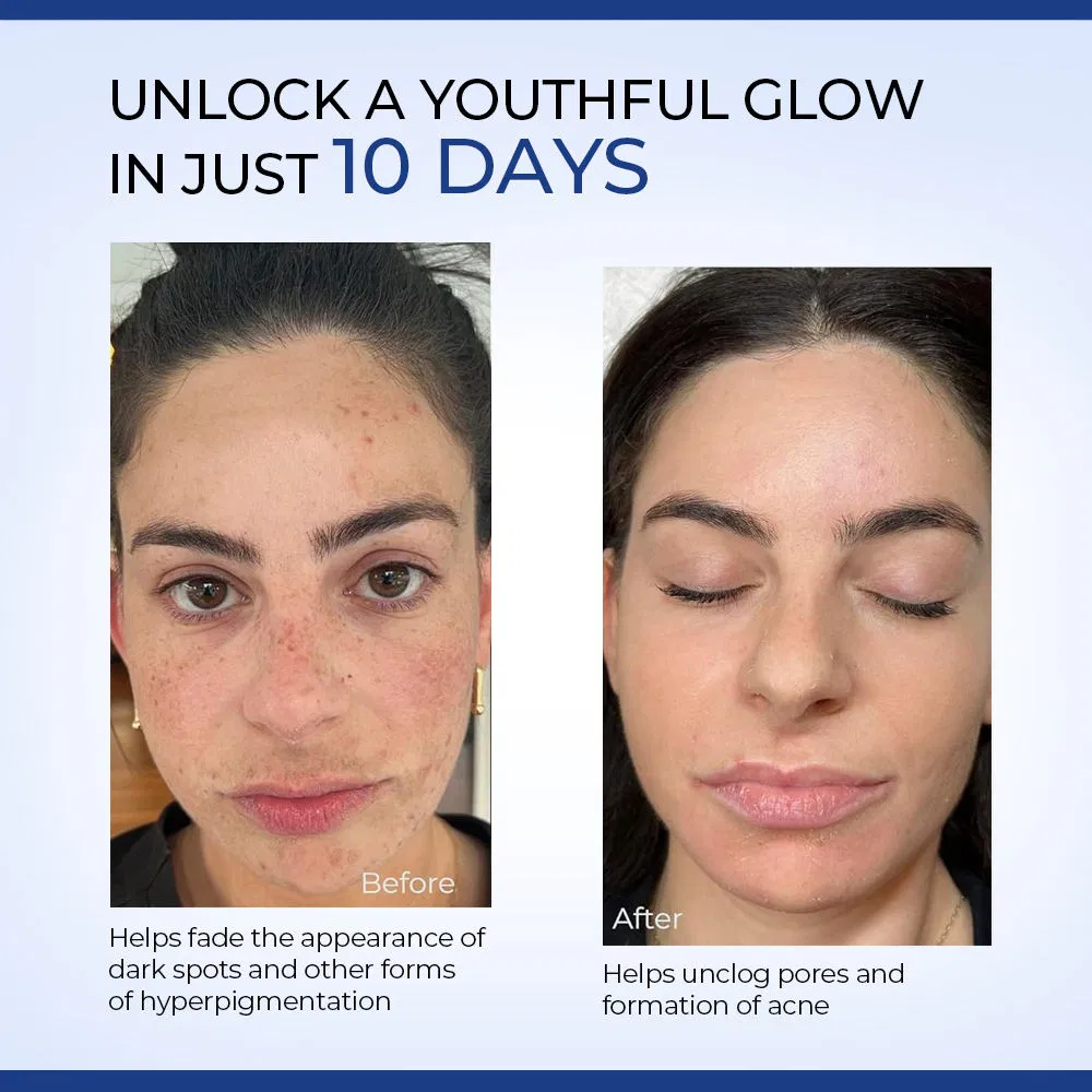 Glycolic Acid Hyaluronic Acid Face Toner Whitening Acne Treatment Hydrating Smooth Brightening