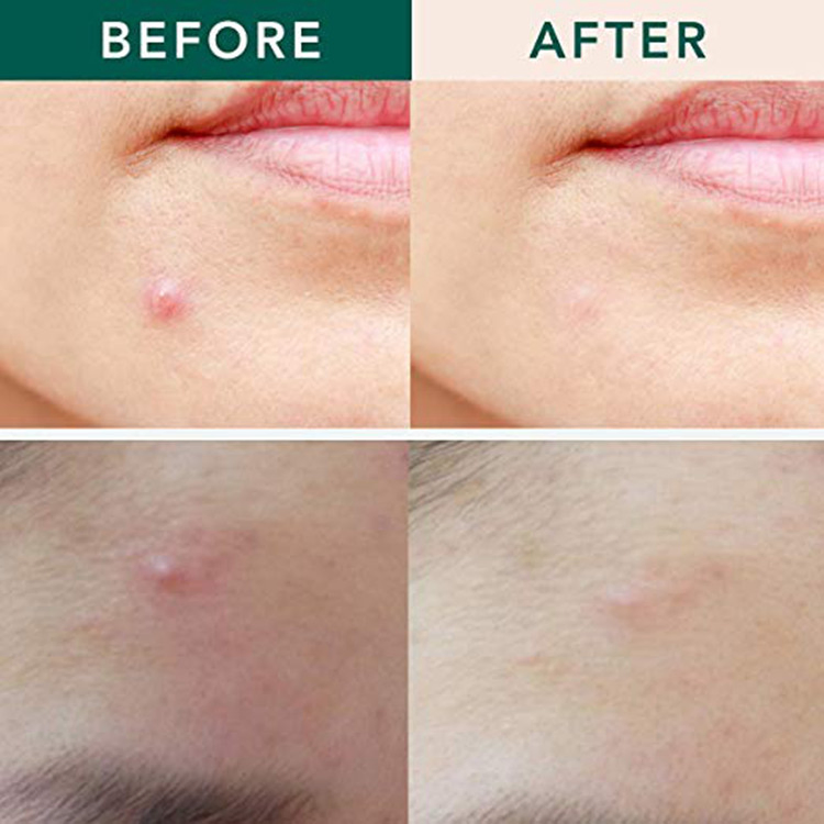 Hyaluronic Acid Microneedle Acne Patch Microcrystalline Patch Acne Removing Patch Manufacturer