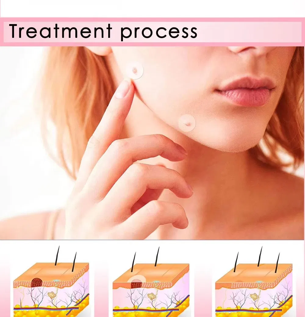 Wholesale Factory Price Private Label OEM Hydrocolloid Acne Patch, Pimple Patch and Spot Patch for Blemish and Zit