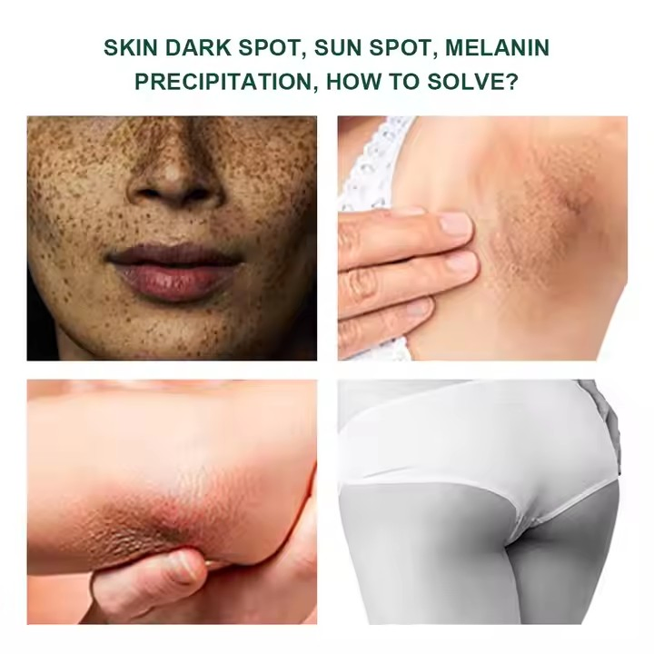 Factory Price Highly Effective OEM Natural Vegan Neck Facial Vitamin C Acne Pimples Dark Spot Strong Freckle Remover Cream