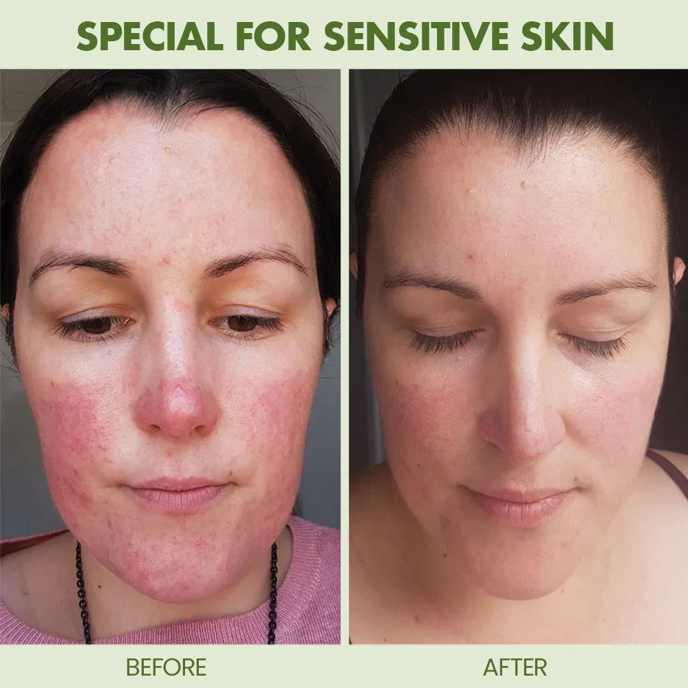 Sensitive Skin Care Products Redness Relief Anti-Allergy Moisturizing Facial Toner