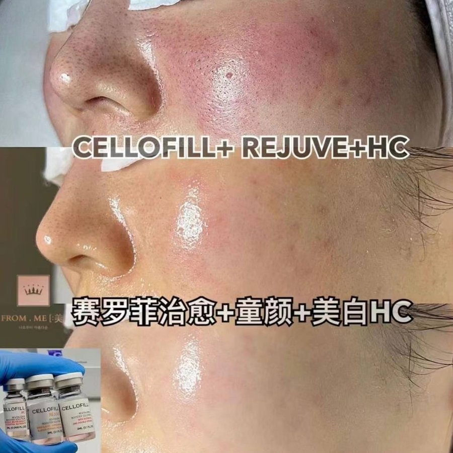 Korea's Best-Selling Whitening Product Cellofill Hc Is a CE-Certified Skin Enhancer That Effectively Removes Skin Wrinkles, Acne Marks, Spots