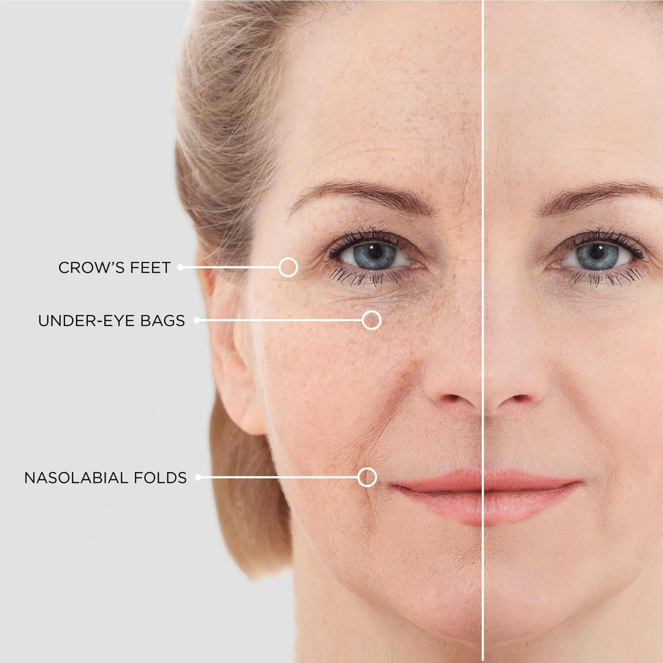 OEM Microneedles Eye Mask with Hyaluronic Acid Eye Patches Skin Care for Dark Circles Moisturizing Anti Wrinkle