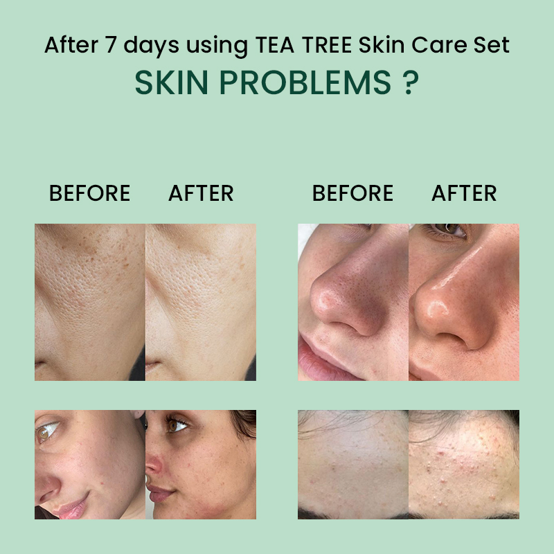 Beauty Skin Care Whitening Acne Remover Anti-Aging Tea Tree Skincare Set