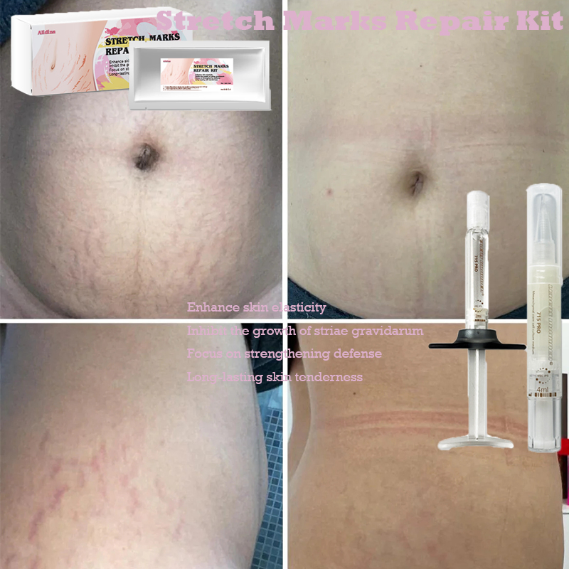 Stretch Marks Permanent Reduce Cream Eliminate Body Belly Stretch Marks Swelling Marks Reduce Skin Cracks Repair Firming Care