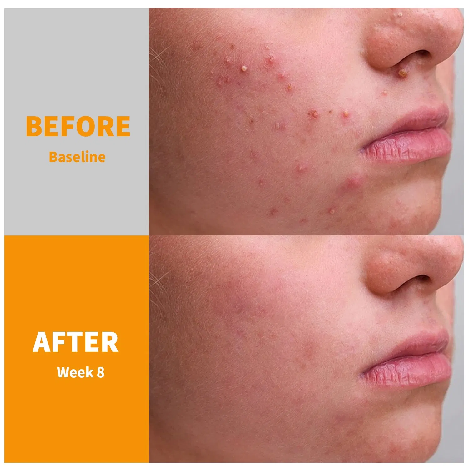 Qbeka Professional Anti-Freckle Brightening Cream for Men & Women - Daily Spot Treatment