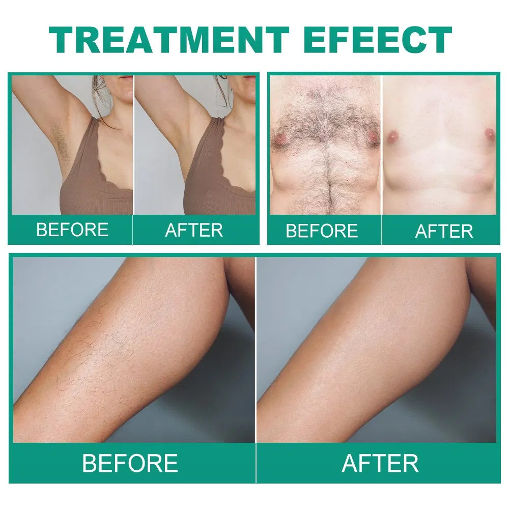 Professional Electrocauter Skinhair Care Device Electrolysis Hair Removal Machine with Needle Portable