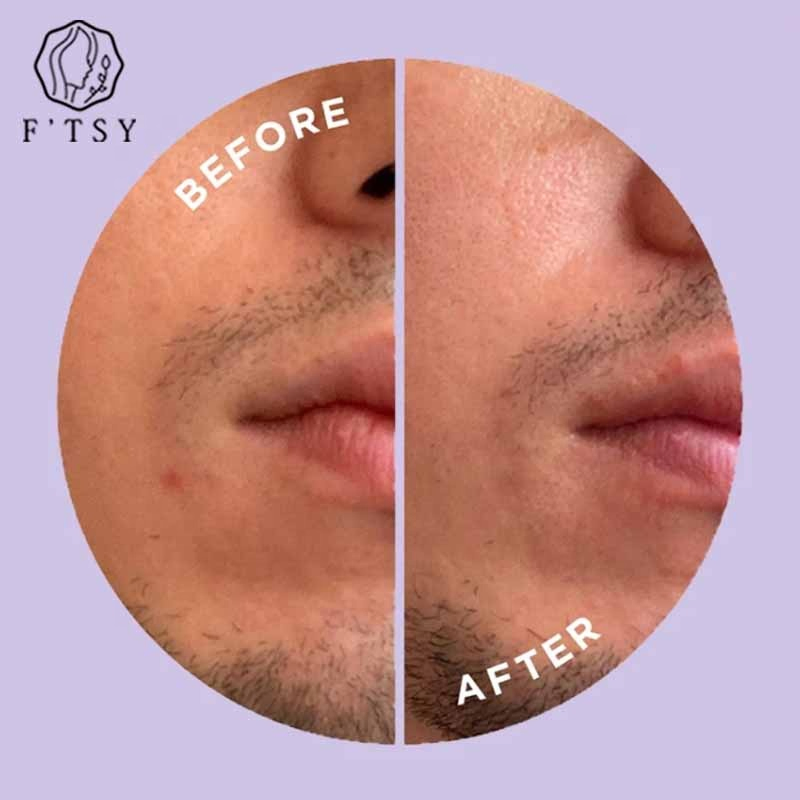 Hot Sale OEM Private Label Organic Microneedle Hyaluronic Acid Acne Removal Pimple Repair Skin Care Microneedle Pimple Patch