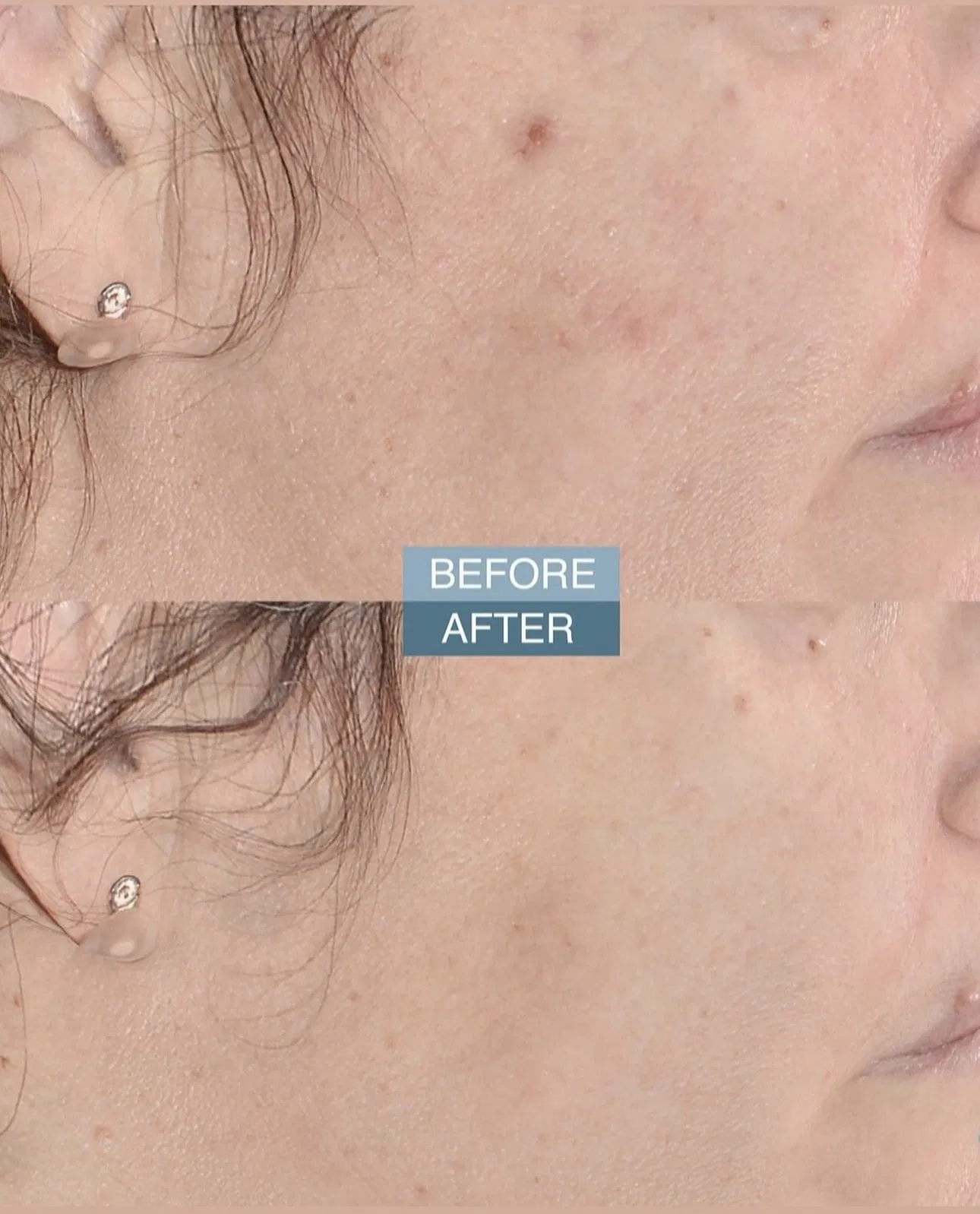 Exoma Exo-Skine Exosome Like Cosmetic Regenerative Complex High Concentration of Synthetic Exosomes Exoblanc Filler