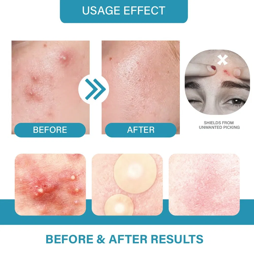 Пластыри от прыщей с салициловой кислотой и витамином С