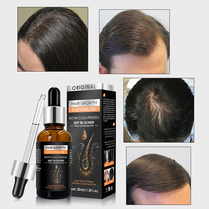 Private Label Hair Care Growth Oil Biotin Regrowth Treatment for Scalp Hair Loss Thinning Hair Growth Essential Oil