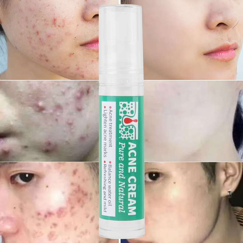 Natural Oil Control Shrink Pores Cleaning Skin Care Whitening Acne Treatment Cream