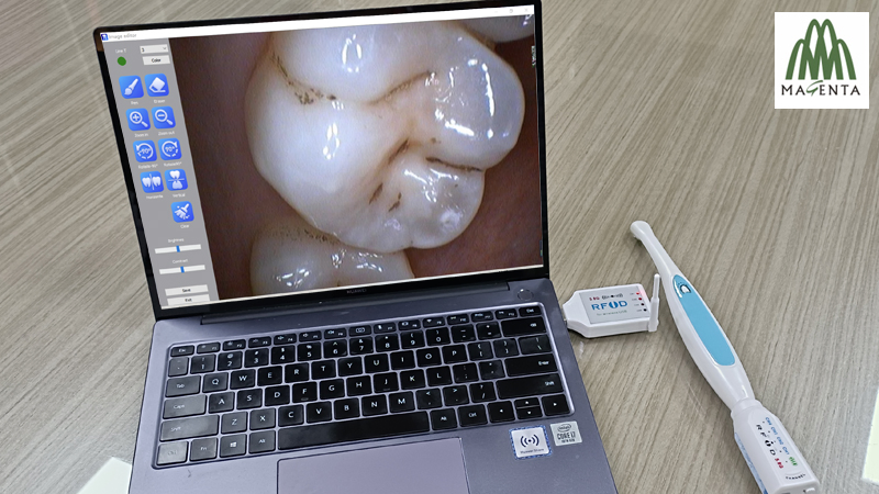 (Magenta) Cordless USB Dental Intraoral Camera for PC Computer