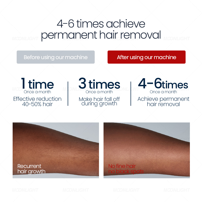 Factory Price Hair Removal Technology Painless Removal Laser FDA Permenant for Professional Device Machine