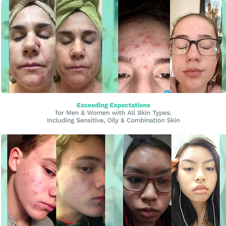 Hot Selling Pore Minimizer Facial Astringent Acne Treatment Witch Hazel Purifying Toner