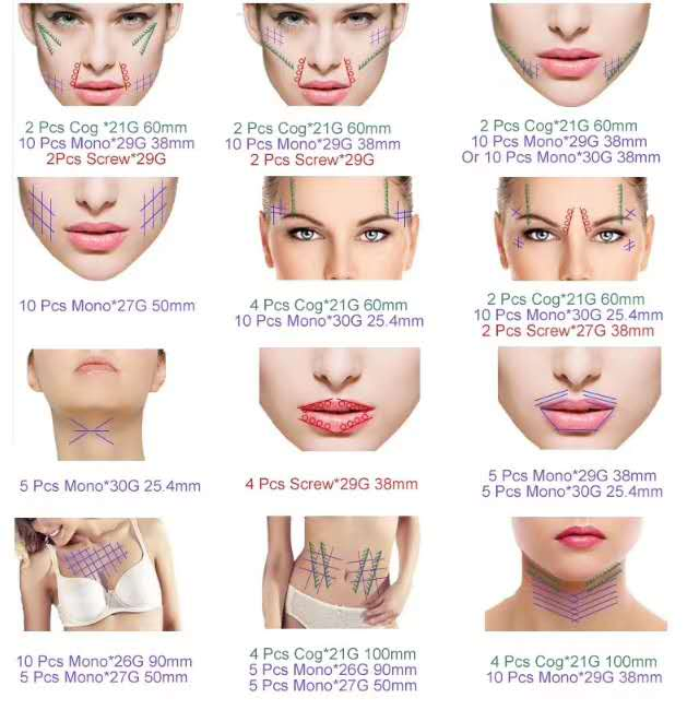 Factory Sale Thread Lift Face /Pdo Thread Lift /Plla Lifting Thread