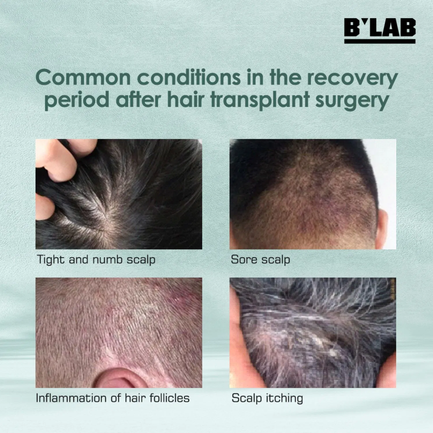 OEM Natural Head Scalp Care After Hair Transplant Repairing Cream