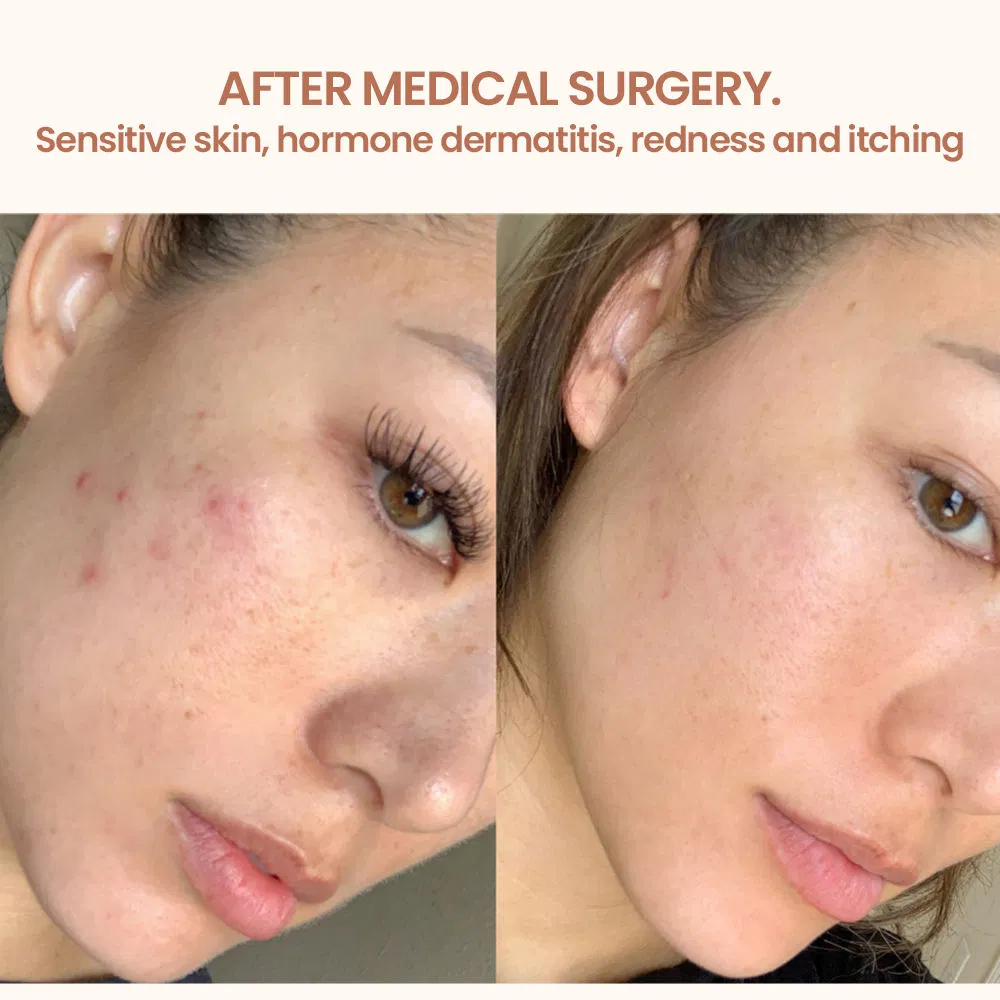 Sensitive Face Toner Redness Relief Anti-Allergy Hydrating Facial Toner