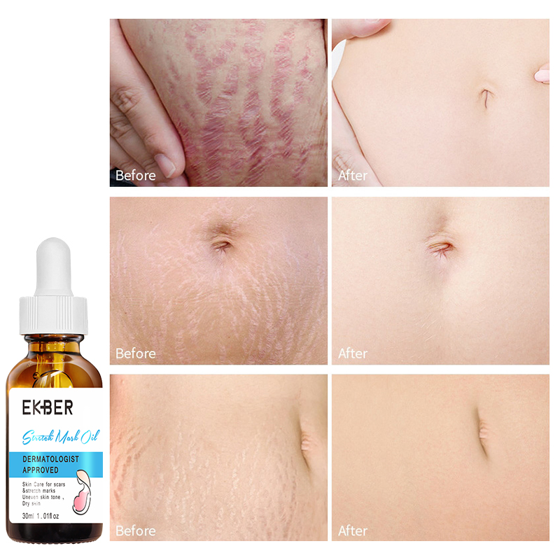 Private Label Natural Organic Fresh Extract Repairing Stretch Marks Skin Care Stretch Mark Oil