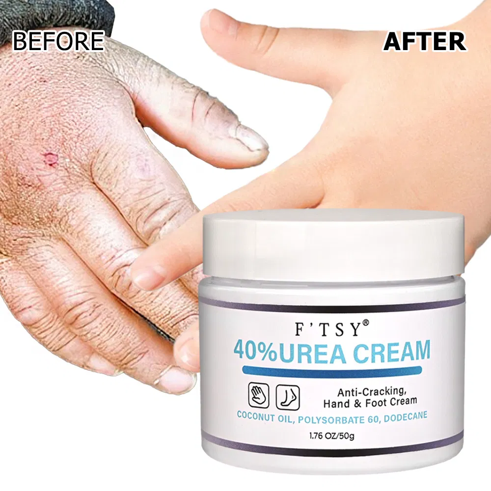 Private Label Anti Cracking 40% Urea Cream with Coconut Oil Moisturizer Hand Foot Cream