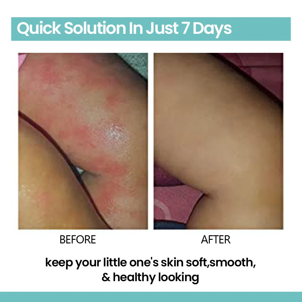 Baby Kids Body Lotion Soothe Itch Dry Skin Inflammation Eczema Rashes