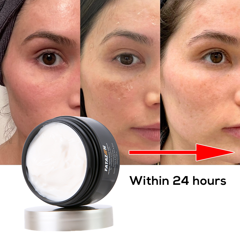 Anti Aging Wrinkles Moisturiser Hyaluronic Acid Facial Firming Whitening Acne Treatment Cream