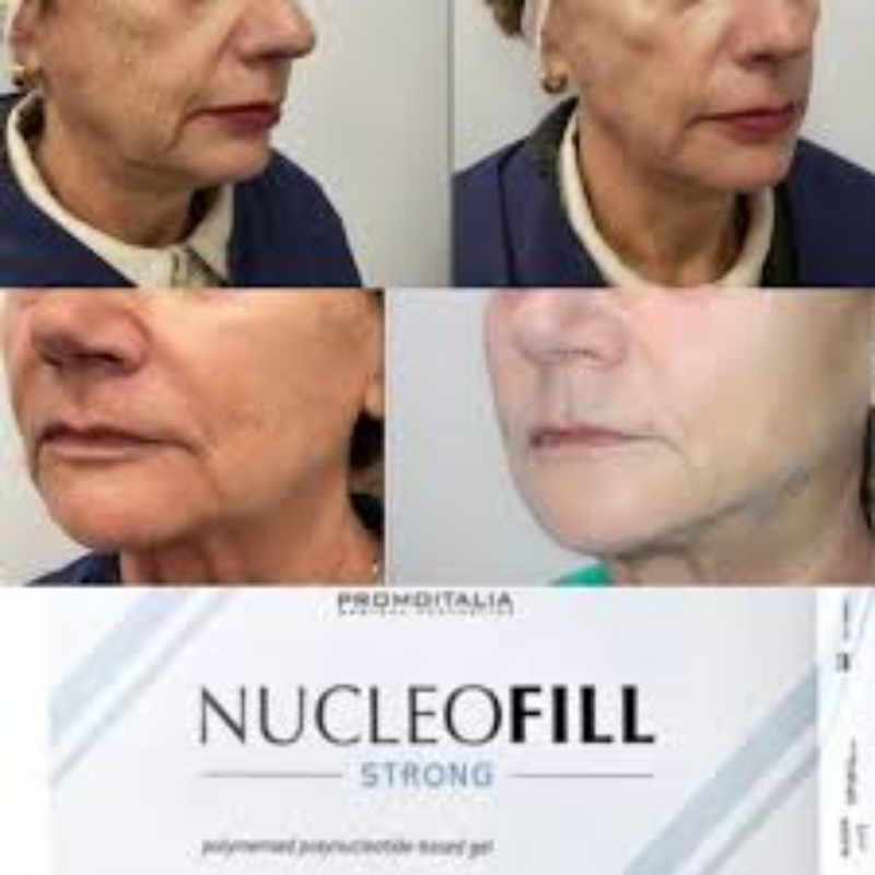 Hot Selling Face Lifting Injection Nucleofill Strong Pn 2.5% Polynucleotides Face Eye Anti Wrinkle Skin Booster Collagen Injection Profhilo H+L Nucleofill