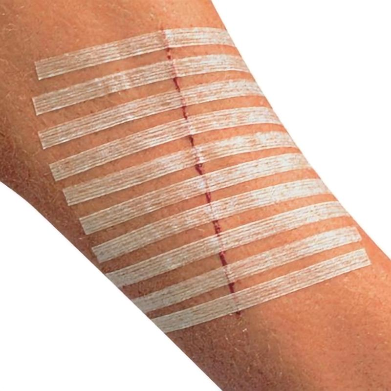 Wound Skin Closure Medical Adhesive Tape for Wound Dressing