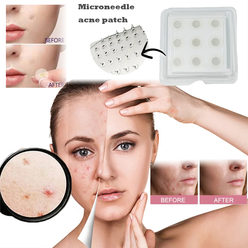 OEM White Microneedles Anti Aging Eye Patch Round Acne Pimple Patch Dissolved Micro Needle Acne Dark Spot Removal Patch