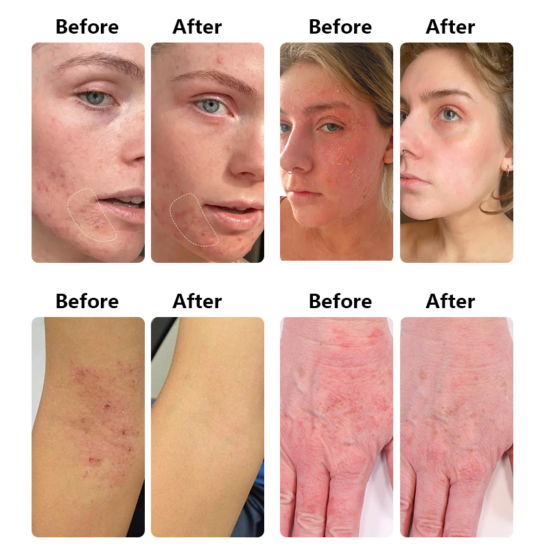 Private Label Soothing Eczema Moisturizing Cream Chinese Herbal Moisturizer Relieves Eczema-Prone Skin