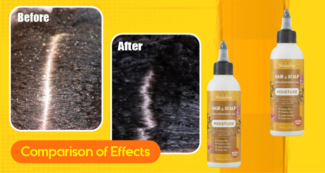 Shakebar Brand Natural Organic Scalp Itching Oil