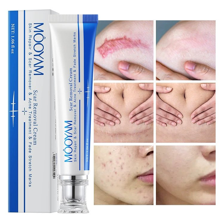 Strong Effective Acne Scar Cream Pimples Stretch Marks Face Cream