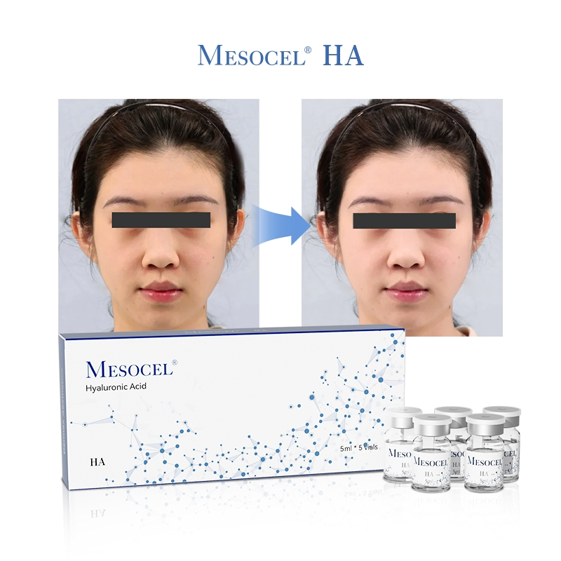 Higher Concentration Skin Care Product for Mesotherapy Solution with Hyaluronic Acids