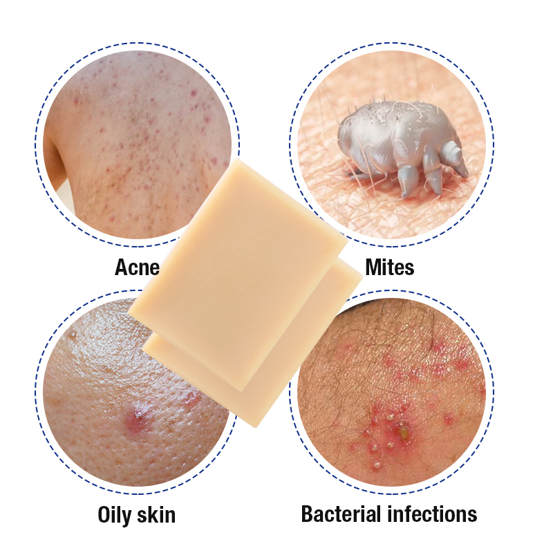 Refreshing Deep Cleansing Nourishing Remedy Remove Mites Anit-Acne Tea Tree Soap