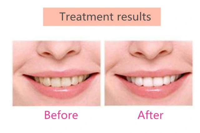 Лампа для отбеливания зубов синим светом SolanaBeauty