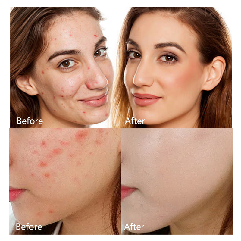 Пластыри от прыщей с микроиглами, медицинский класс