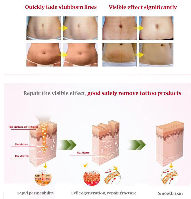 OEM Anti-Wrinkle Stretch Mark Cream Postpartum Repair Scar Slack Line for Woman