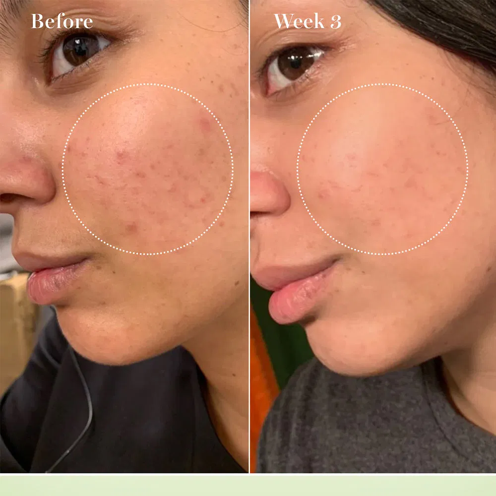 10% Glycolic Acid Hyaluronic Acid Acne Treatment Hydrating Brightening Face Toner