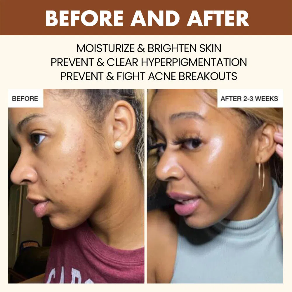 Black Skin Brightening Acne Treatment Pore Minimize Exfoliating Skin Face Toner