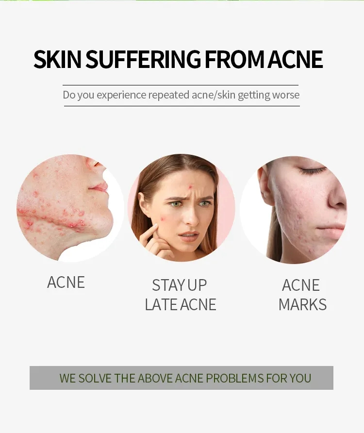 Hot Selling Private Label 100% Organic Green Tea Anti-Acne Cream