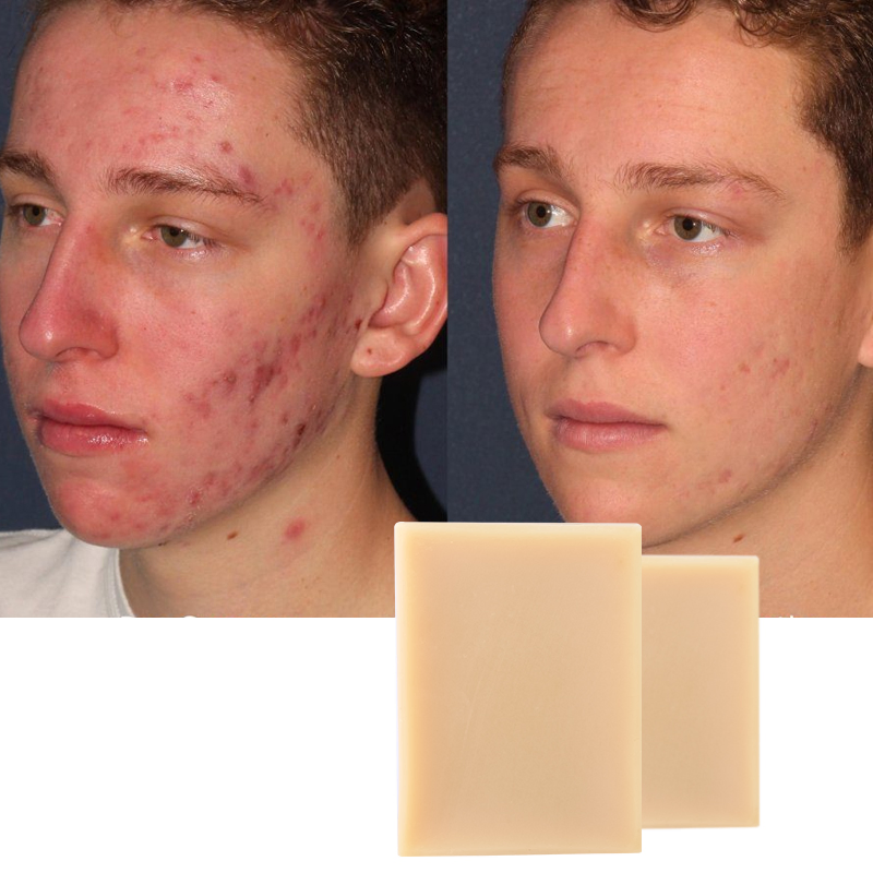 Refreshing Deep Cleansing Nourishing Remedy Remove Mites Anit-Acne Tea Tree Soap