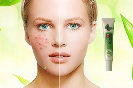 Hot Selling Private Label 100% Organic Green Tea Anti-Acne Cream